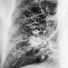 Bronchiectasis
Case 3 PA bronchogram