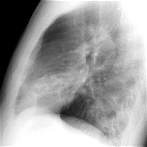 Bronchiectasis
Case 3 Lat