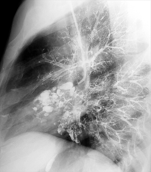 Bronchiectasis
Case 3 Lat bronchogram