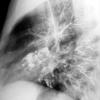 Bronchiectasis
Case 3 Lat bronchogram