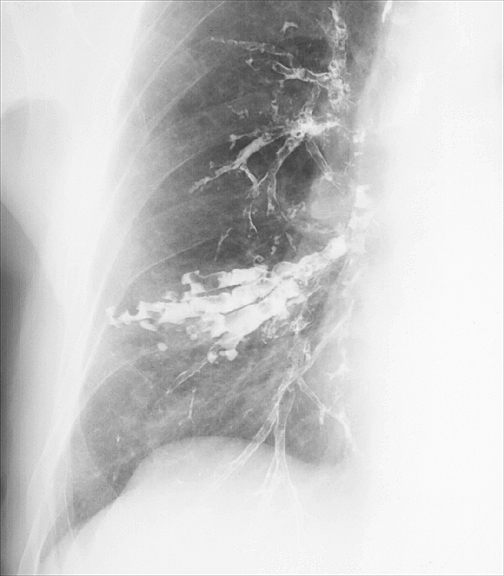 Bronchiectasis
Case 4 