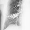 Bronchiectasis
Case 4 