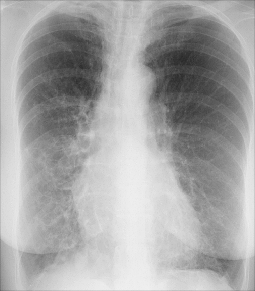 Bronchiectasis
Case 5 PA