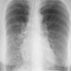 Bronchiectasis
Case 5 PA