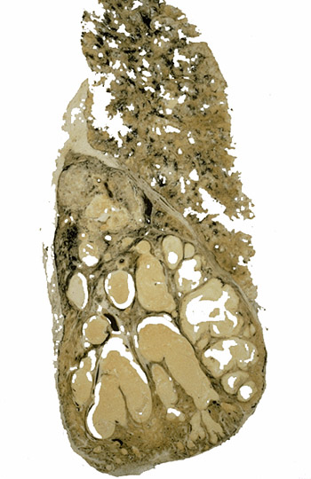 Bronchiectasis
Gough section