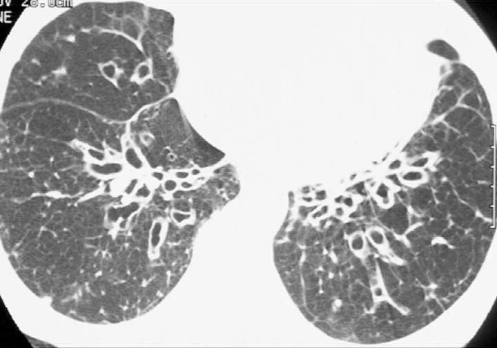 Bronchiectasis
Case 6 CT