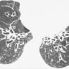 Bronchiectasis
Case 6 CT