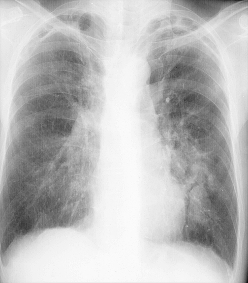 Bronchiectasis
Case 7b PA