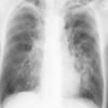 Bronchiectasis
Case 7b PA