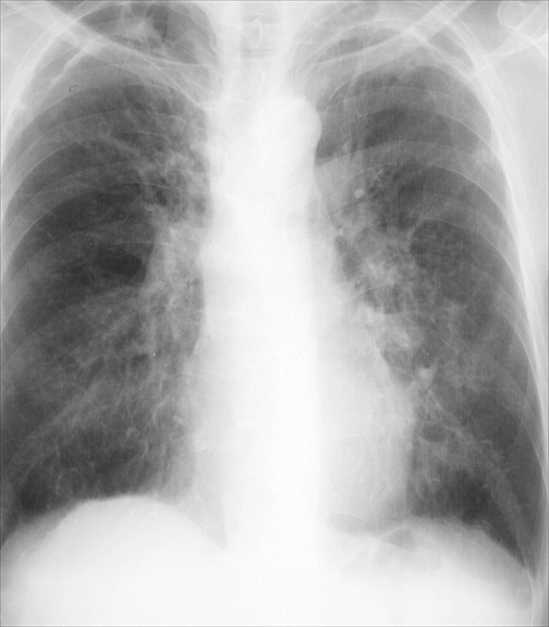 Bronchiectasis
Case 7a PA