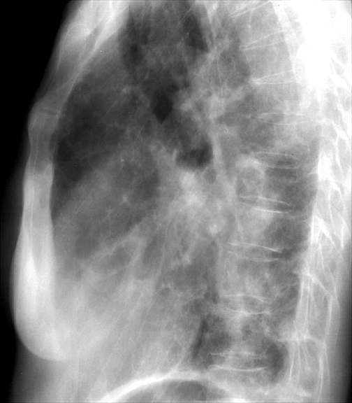 Bronchiectasis
Case 7a Lat