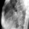 Bronchiectasis
Case 7a Lat