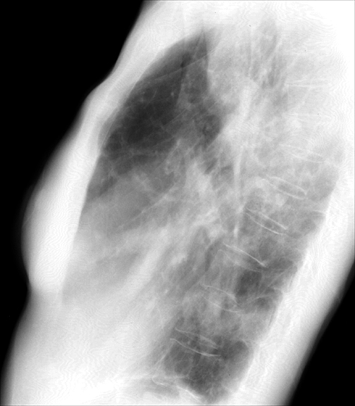 Bronchiectasis
Case 7b Lat