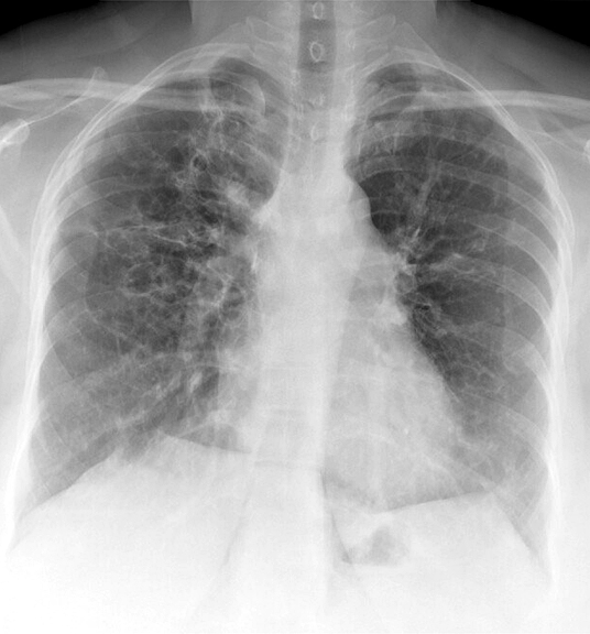 Bronchiectasis
Case 8 PA