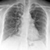 Bronchiectasis
Case 8 PA