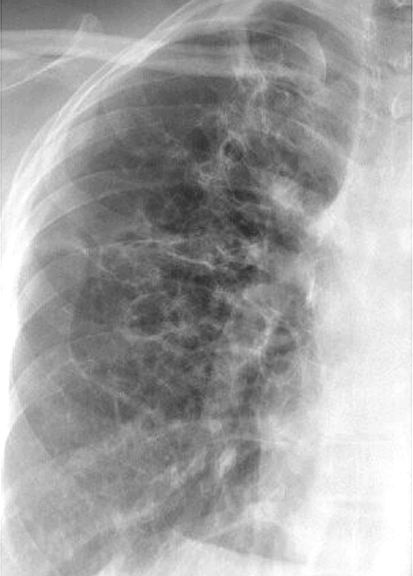 Bronchiectasis
Case 8 PA c/u