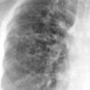 Bronchiectasis
Case 8 PA c/u