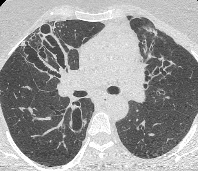 Bronchiectasis
Case 8 CT1