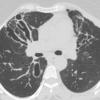 Bronchiectasis
Case 8 CT1