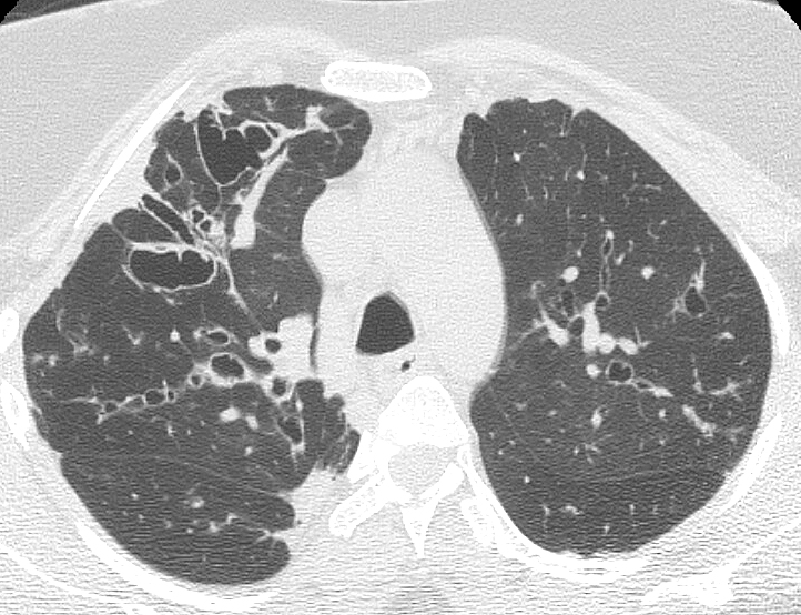 Bronchiectasis
Case 8 CT2