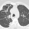 Bronchiectasis
Case 8 CT2