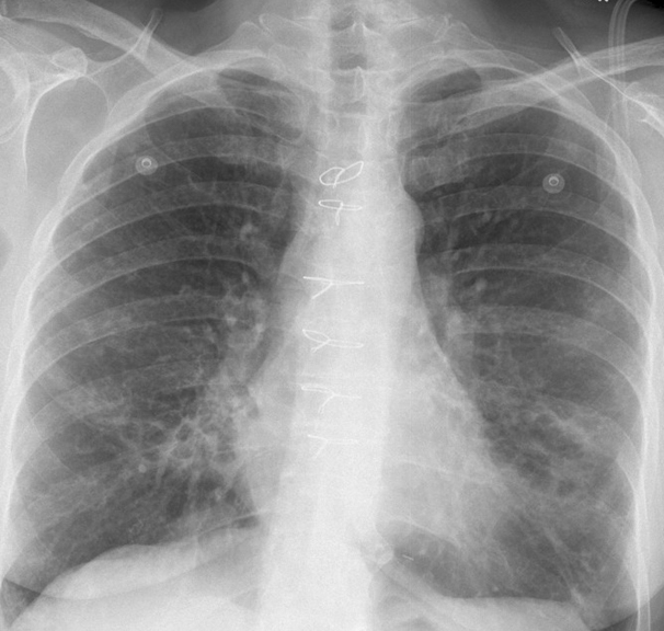 Bronchiectasis
Case 9 PA