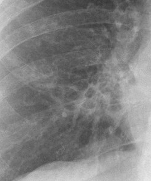 Bronchiectasis
Case 9 PA c/u