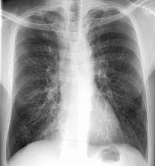 Bronchiectasis
Case 10 PA