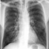 Bronchiectasis
Case 10 PA