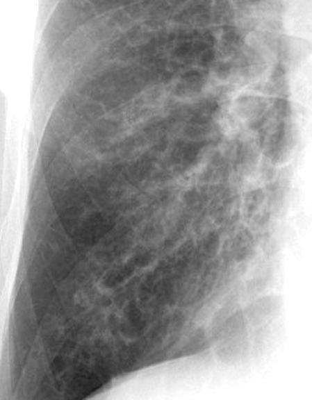 Bronchiectasis
Case 10 PA c/u