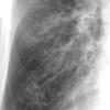 Bronchiectasis
Case 10 PA c/u