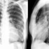 Bronchiectasis
Case 11 PA/Lat