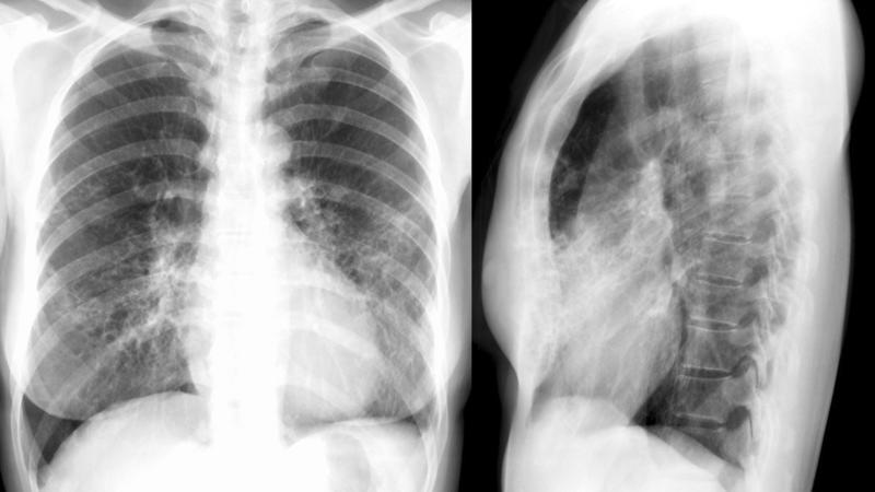 Bronchiectasis
Case 11 PA/Lat