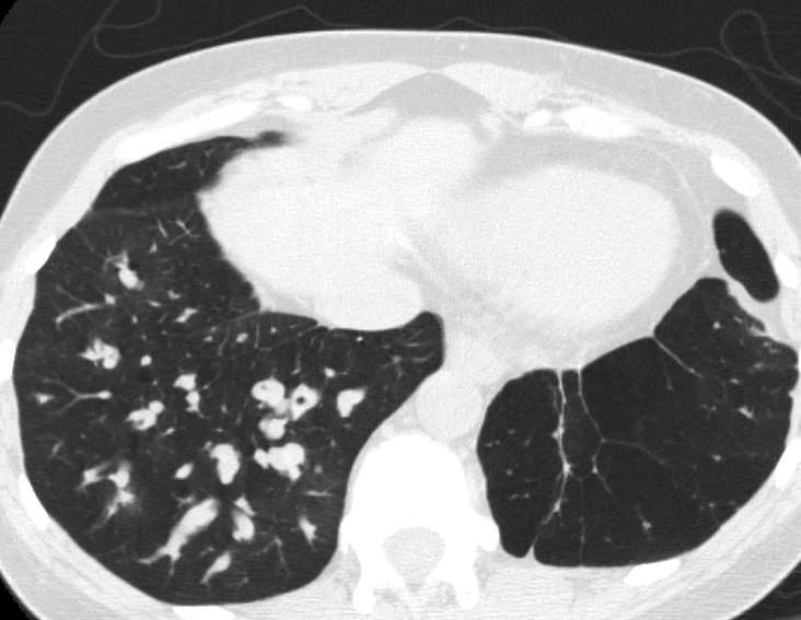 Bronchiectasis
Case 12 CT