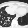 Bronchiectasis
Case 12 CT