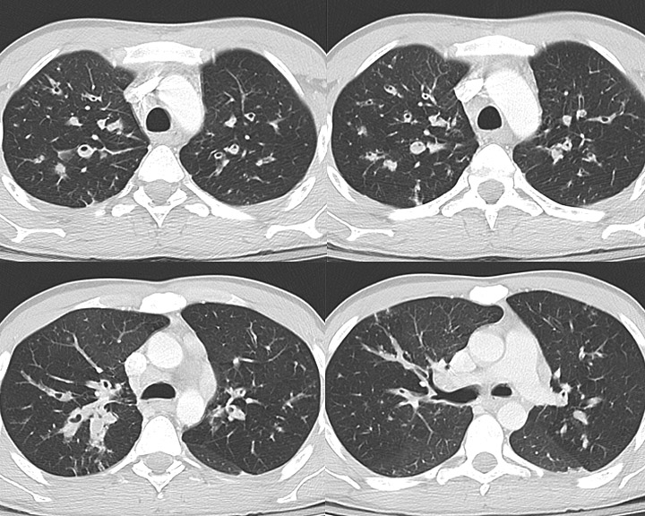 Bronchiectasis
Case 13 CT