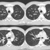 Bronchiectasis
Case 13 CT