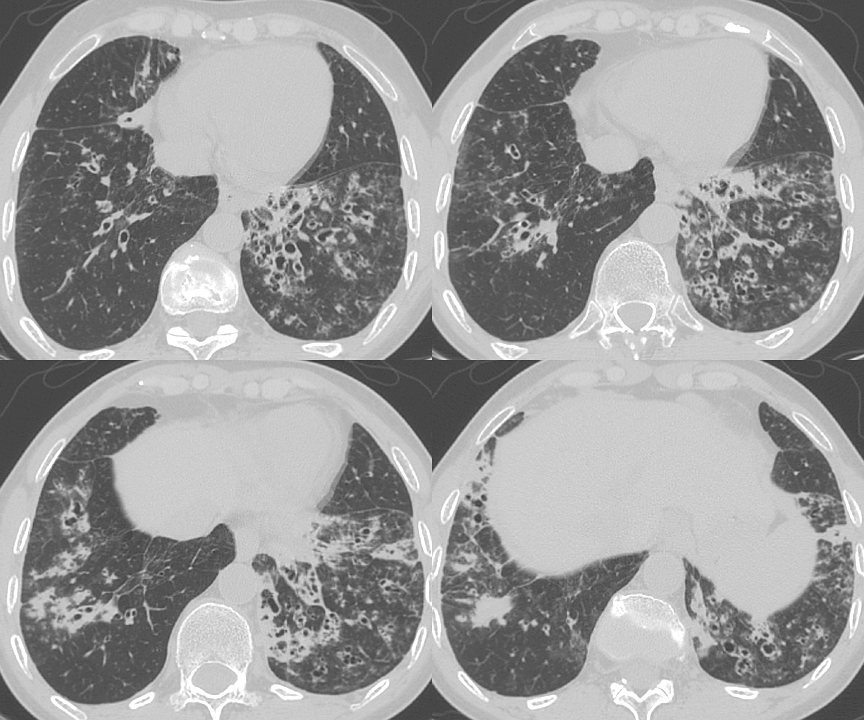 Bronchiectasis Case 14