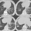 Bronchiectasis Case 14