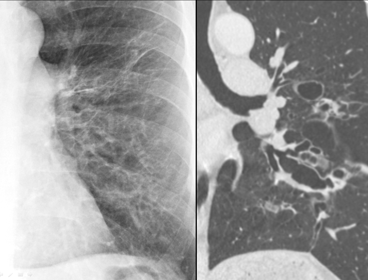 Bronchiectasis with coronal CT