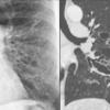 Bronchiectasis with coronal CT