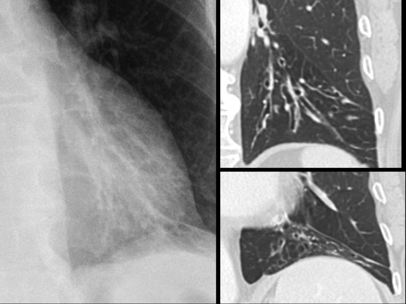 Chronic airway disease