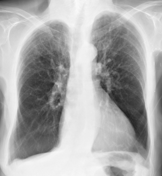 alpha 1 antitrypsin