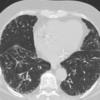 chronic br CT