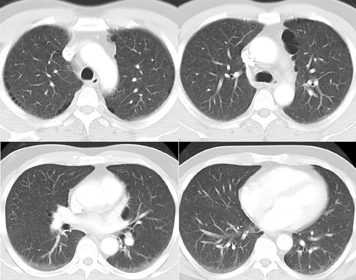 paraseptal