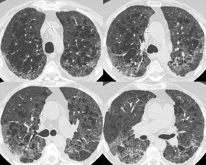 severe copd