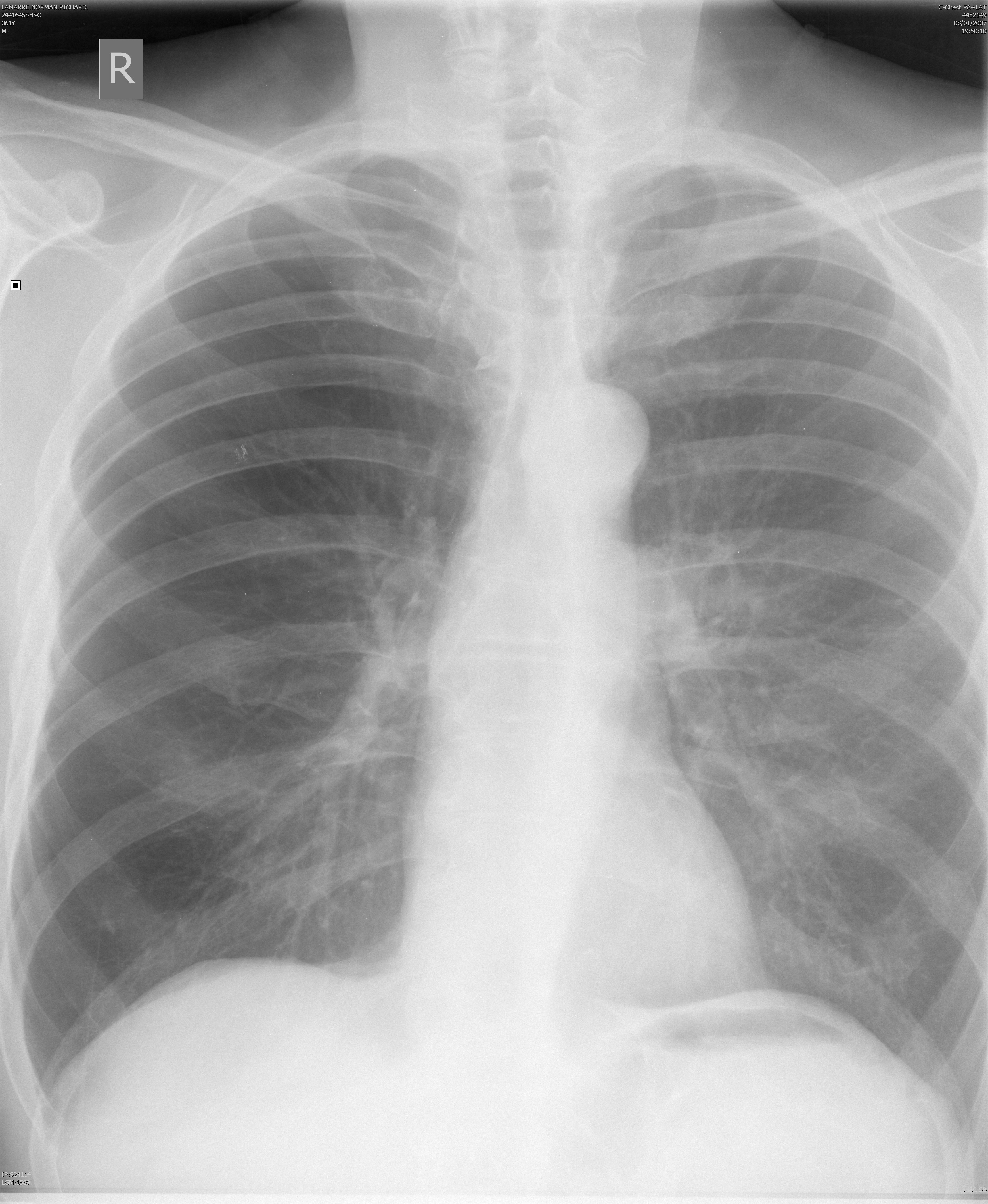 Unilat hyperl lung
(prob post viral)