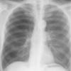 Unilat hyperl lung
(prob post viral)