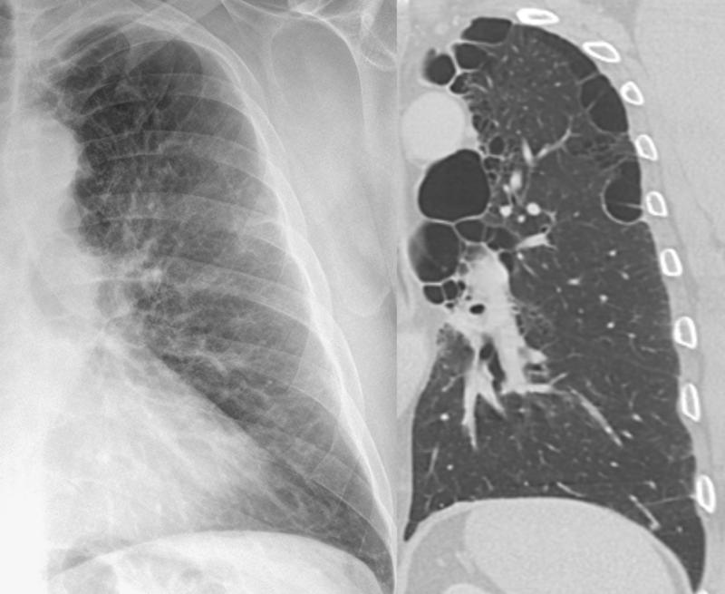 paraseptal emphysema