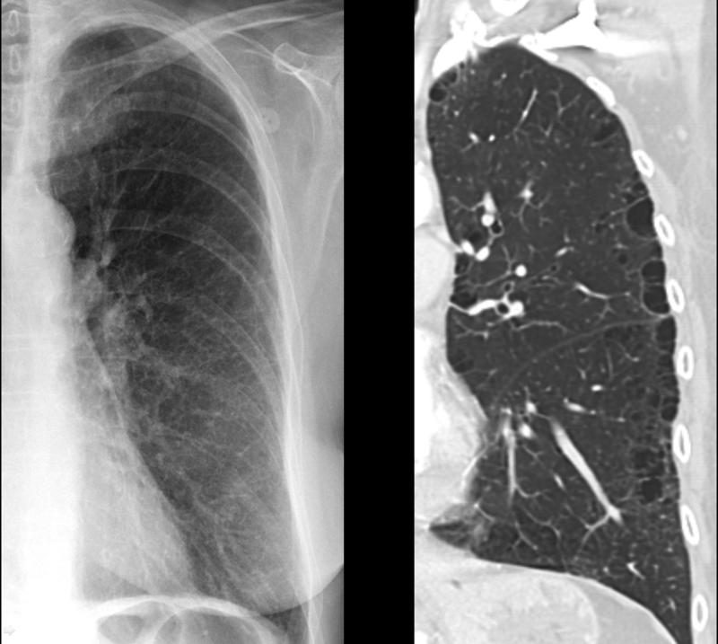 Subtle paraseptal emphysema